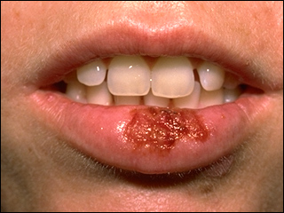 Herpes labial – aprenda aqui como evitar e curar