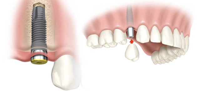 implante dentário